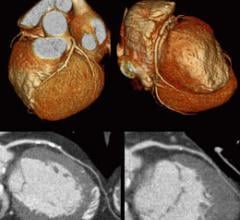  ct-angiogram-plaque