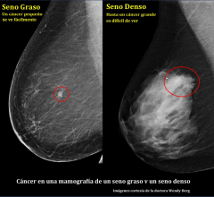 Spanish, breast health, breast density, DenseBreast-info.org