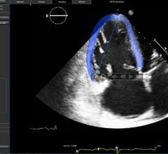 EchoInsight, right ventricle, quantitative assessment, RV, study 