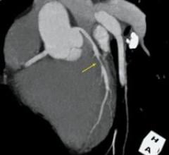 MR Angiography: Better Than CTA?