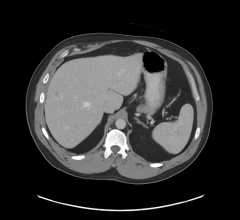 Routine scan of abdomen pelvis taken with the UW-Madison’s Revolution 256 CT scanner using the FDA-cleared reconstruction algorithm, called TrueFidelity.