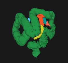 CT colonography (CTC) allows visualization of the entire colon in one image