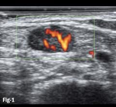 Figure 1. Doppler flows in subpleural consolidation shows smoothly dilated branching arteries 