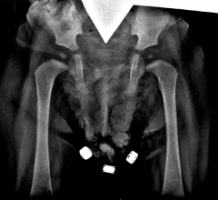 radiation exposure, CT, X-ray, cancer, James Welsh, Jeffry Siegel, Loyola