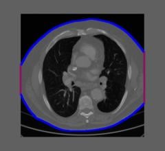 Example of an intentionally truncated CT image