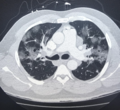 The use of cardiovascular computed tomography angiography (CCTA) is one of the areas that has seen a sudden increase in use and value since the start of the ongoing COVID-19 pandemic. 