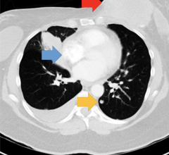 Single-slice of the chest CT showing the abnormalities. Arrows indicate the location of the breast mass (red arrow), lymphadenopathy (blue arrow), and a lung nodule (yellow arrow). Arrows not present in experimental display. Image courtesy of Psychonomic Bulletin & Review