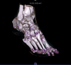 CT Spectral imaging of a foot showing gout. The image was made on a Somatom Force dual energy CT system.