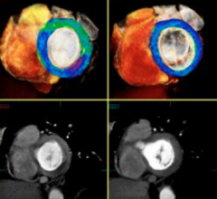 CT myocardial perfusion