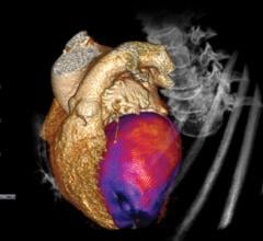 CT perfusion