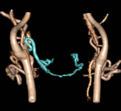 ct systems rsna 2013 imaging