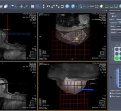 breast MRI, new AB-MR exam protocol, Via Radiology, cancer detection, dense breasts, women's health