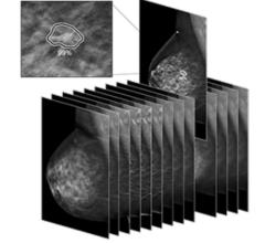 iCAD Reports Strong Momentum of ProFound AI for Digital Breast Tomosynthesis