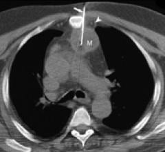 Use of Imaging-Guided Biopsies on the Rise