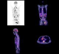 Radiation-Immunotherapy Combination Can Slow Tumor Growth in Some Metastatic Late-Stage Cancer