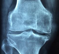 Osteoarthritis