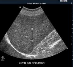 ACR Releases New Core LI-RADS for Ultrasound Imaging