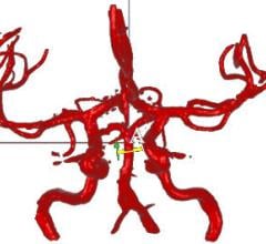 VasSol Inc., NOVA, VERiTAS trial, recurrent stroke, MRI, software