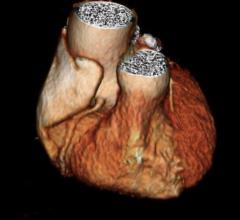 CT Shows Enlarged Aortas in Former Pro Football Players