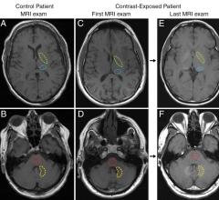 Study Finds No Evidence that Gadolinium Causes Neurologic Harm