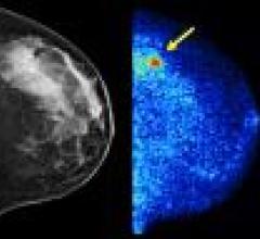 Molecular Imaging to Improve Cancer Detection in Dense Breasts