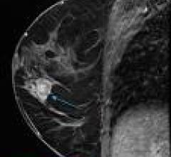 Breast MRI Useful Adjunctive Tool to Inclusive Mammography, US