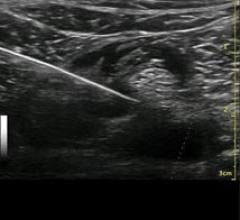 musculoskeletal, MSK, ultrasound, Soundwaves, Florida