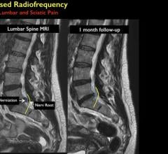 Minimally Invasive Treatment Provides Relief from Back Pain