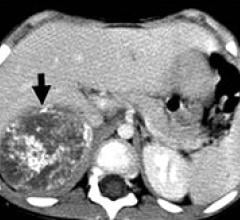  neuroblastoma