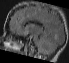 neuroimaging, CT, MRI, children, adolescents, sports-related concussions, JNS