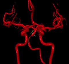 recurrent stroke risk, low blood flow, vertebrobasilar region, NOVA, UIC