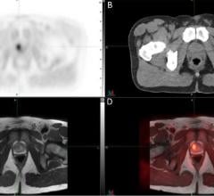 Study Demonstrates First Human Application of Novel PET Tracer for Prostate Cancer