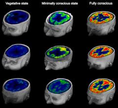 FDG-PET, brain injured patients, awareness, Current Biology study