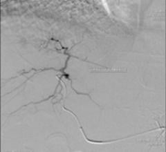 Arteriogram - questionable hypervascular mass