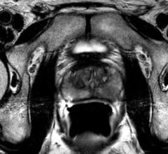 prostate cancer, biomarkers, AUA, mpMRI, biopsy