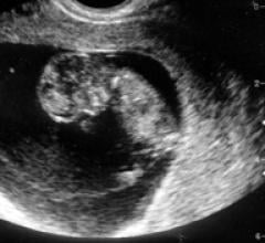 Abortion and the Politics of Forced Ultrasound