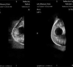 3-D Whole Breast Ultrasound