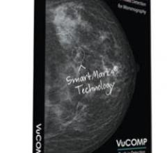 mammography systems rsna computer aided detection women's health vucomp konica