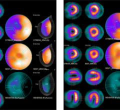 Cardiac SPECT Camera Reduces Time, Radiation