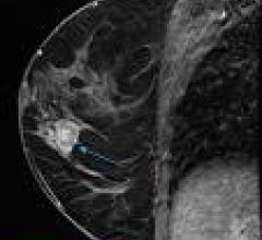 MRI Technique Means Fewer Breast Biopsies in High-Risk Women