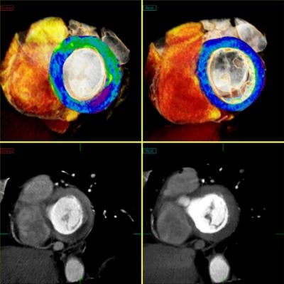 Toshiba CT Myocardial Perfusion Advanced Visualization CT Systems