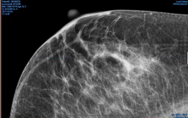 Breast Density Inform Bill Mammography Systems Women's Healthcare