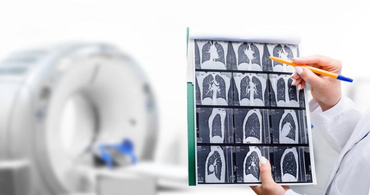 In a newly-published study, American Cancer Society researchers found that less than one-in-five eligible individuals in the United States were up-to-date (UTD) with recommended lung cancer screening (LCS).
