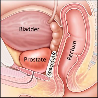 New Prostate Cancer Radiotherapy Technique Aims to Preserve Sexual