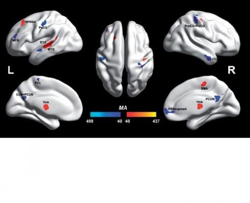 autism, fMRI, University of Warwick, voxels, BWAS