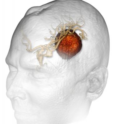 aggressive brain cancer, glioblastomas, combination therapy, Sidney Kimmel Cancer Center study, Thomas Jefferson University