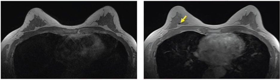 Contrast-Enhanced In-Phase Dixon Sequence: Impact on Biopsy Clip Detection  on Breast MRI