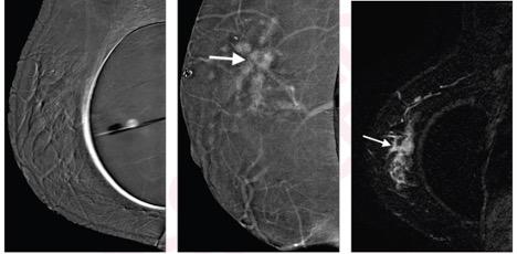 Contrast Enhanced Mammography for Breast Cancer in Women With