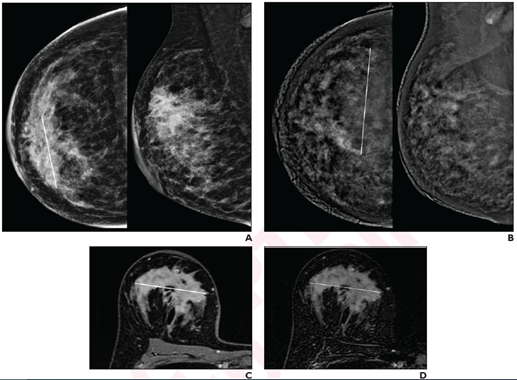 Imaging in Breast Cancer