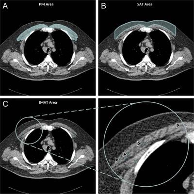 Chest CT Illuminates Mortality Risk in People with COPD Imaging